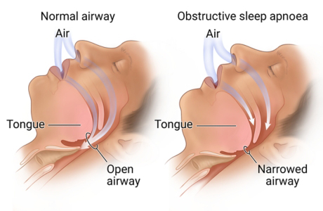 Obstructive Sleep Apnoea in Mitchell Park, Marion, Adelaide SA - Marion ...